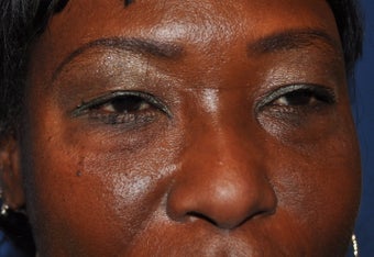 Blepharoplasty (Upper and Lower eyelids)