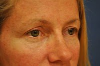 Blepharoplasty (Upper eyelids)