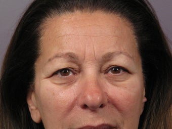 Eyelid Surgery 