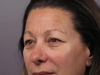 Eyelid Surgery 