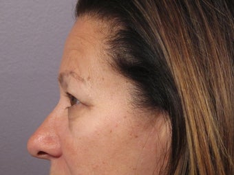 Eyelid Surgery 