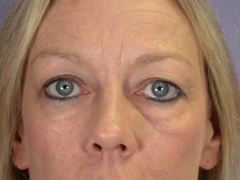 Eyelid Surgery
