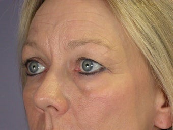 Eyelid Surgery