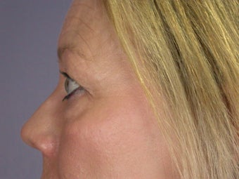 Eyelid Surgery
