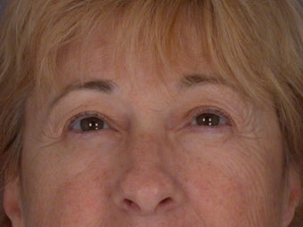 Eyelid Surgery