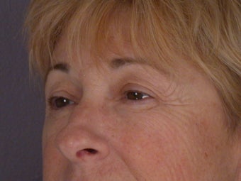 Eyelid Surgery