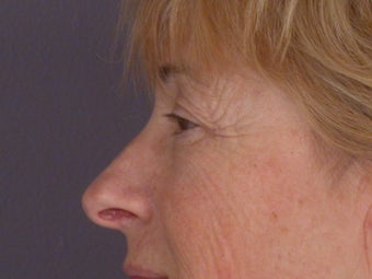 Eyelid Surgery