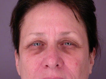 Eyelid Surgery