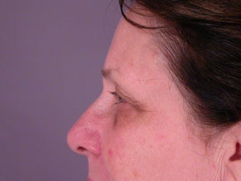 Eyelid Surgery