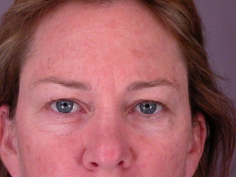 Eyelid Surgery