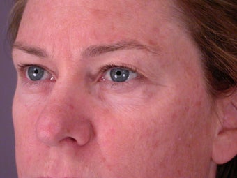 Eyelid Surgery