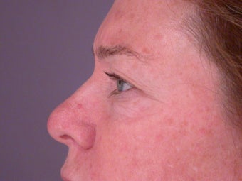 Eyelid Surgery