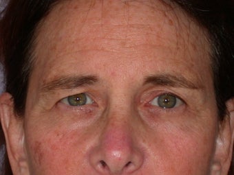 Eyelid Surgery 