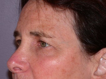 Eyelid Surgery 