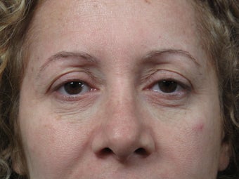 Eyelid Surgery 
