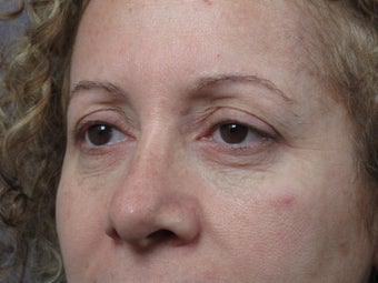Eyelid Surgery 
