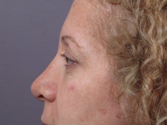 Eyelid Surgery 
