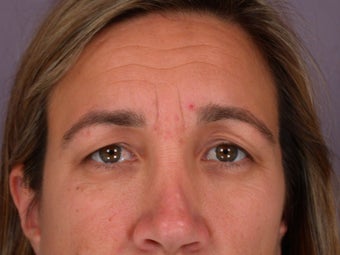 Eyelid Surgery 