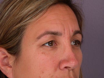 Eyelid Surgery 