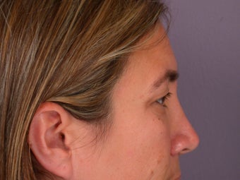 Eyelid Surgery 