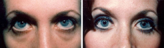 Blepharoplasty-Mid Face