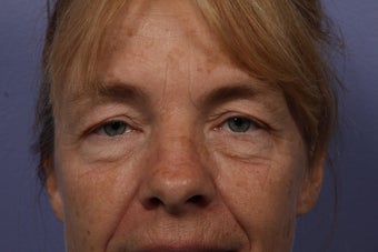 Eyelid Surgery