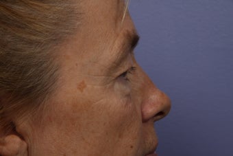 Eyelid Surgery