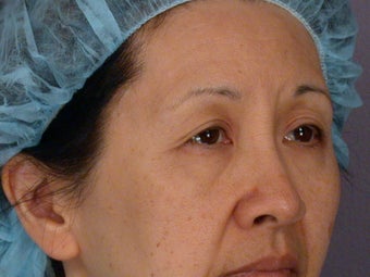 Eyelid Surgery