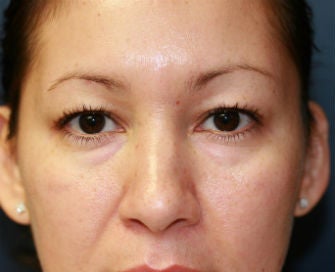 Upper and Lower Eyelid Blepharoplasty
