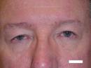 Eyelid Surgery (Blepharoplasty)