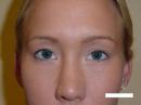 Eyelid Surgery (Blepharoplasty)