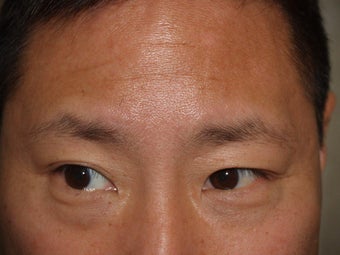 Lower Lid Blepharoplasty
