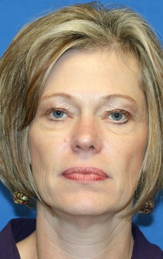 Eye Rejuvenation