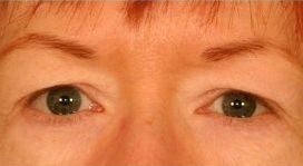 Upper Blepharoplasty (Upper Eyelids)