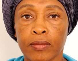 Lower Blepharoplasty (Lower Eyelids)