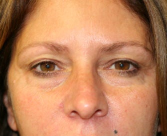 Lower eyelid blepharoplasty