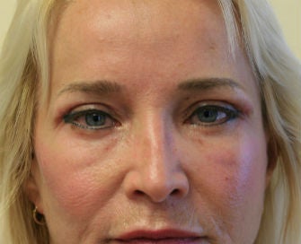 Eyelid rejuvenation