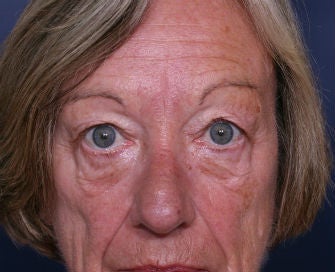 eyelid blepharoplasty
