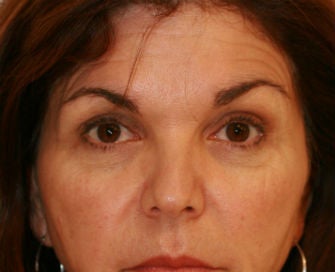Lower eyelid blepharoplasty
