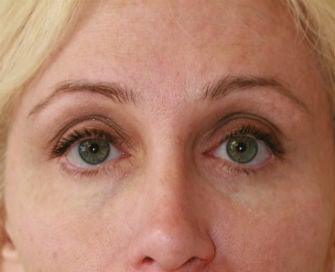 Eyelid rejuvenation