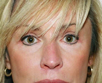 eyelid procedure