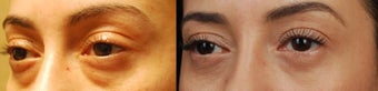 Bilateral Upper Eyelid Blepharoplasty