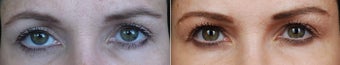 Right revision ptosis repair