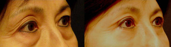 Lower Eyelid Surgery