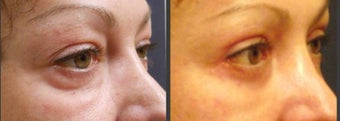 Upper & Lower eyelid surgery