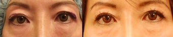 Upper eyelid surgery