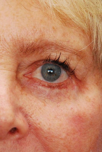 Lower eyelid reconstruction