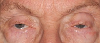 Ptosis and ectropion repair