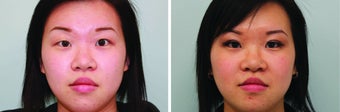 Double Eyelid Surgery Suture