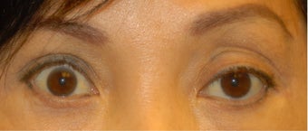 Ptosis Correction